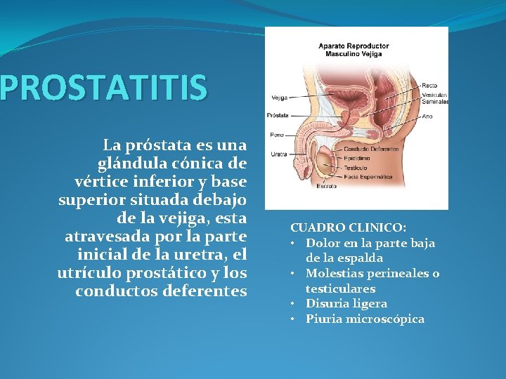 PROSTATITIS La próstata es una glándula cónica de vértice inferior y base superior situada