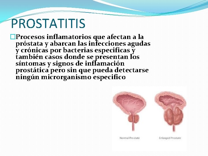 PROSTATITIS �Procesos inflamatorios que afectan a la próstata y abarcan las infecciones agudas y