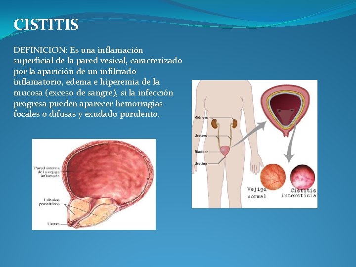 CISTITIS DEFINICION: Es una inflamación superficial de la pared vesical, caracterizado por la aparición