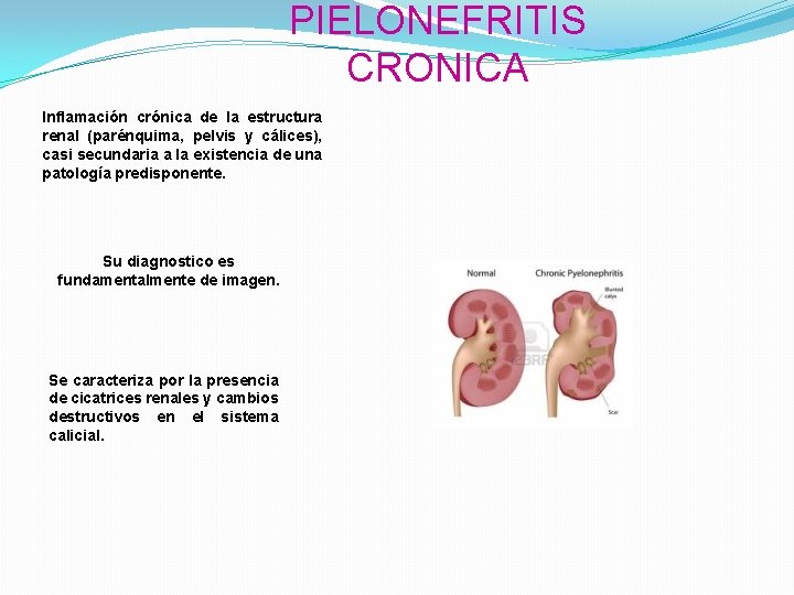 PIELONEFRITIS CRONICA Inflamación crónica de la estructura renal (parénquima, pelvis y cálices), casi secundaria