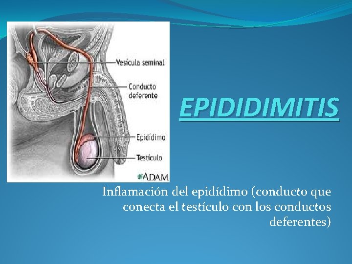 EPIDIDIMITIS Inflamación del epidídimo (conducto que conecta el testículo con los conductos deferentes) 