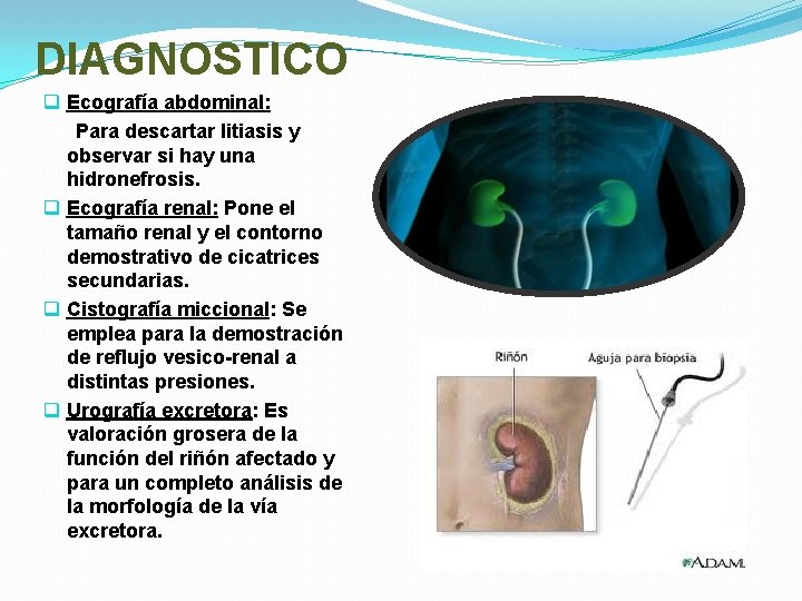 DIAGNOSTICO q Ecografía abdominal: Para descartar litiasis y observar si hay una hidronefrosis. q