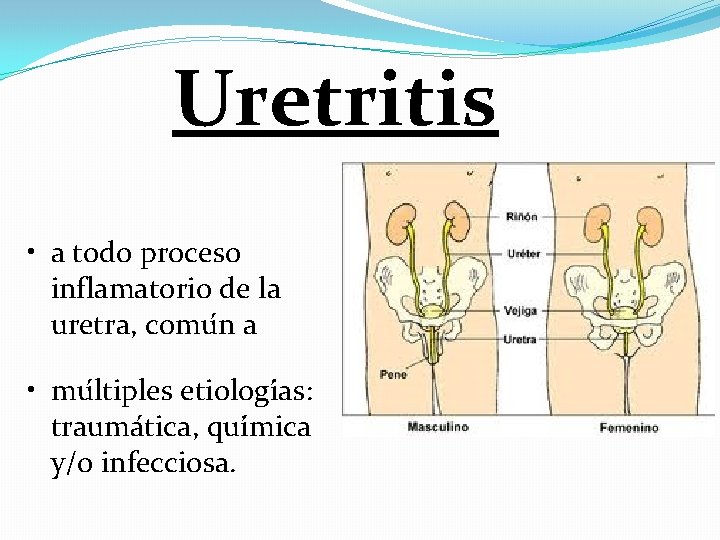 Uretritis • a todo proceso inflamatorio de la uretra, comu n a • mu