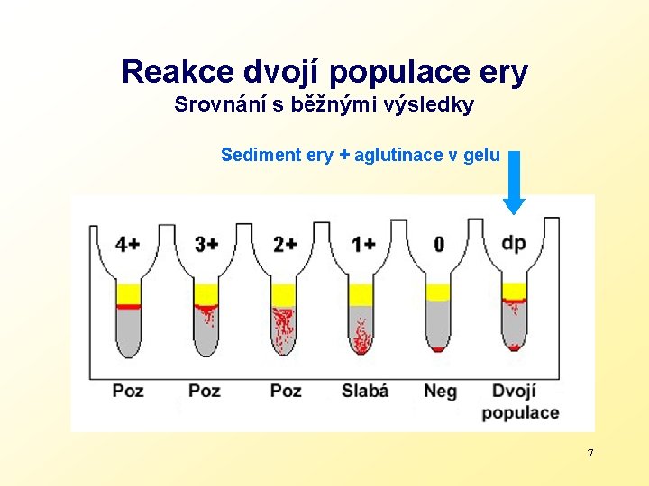 Reakce dvojí populace ery Srovnání s běžnými výsledky Sediment ery + aglutinace v gelu