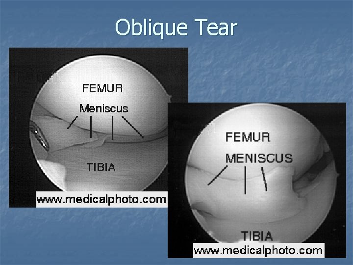 Oblique Tear Oblique Tear