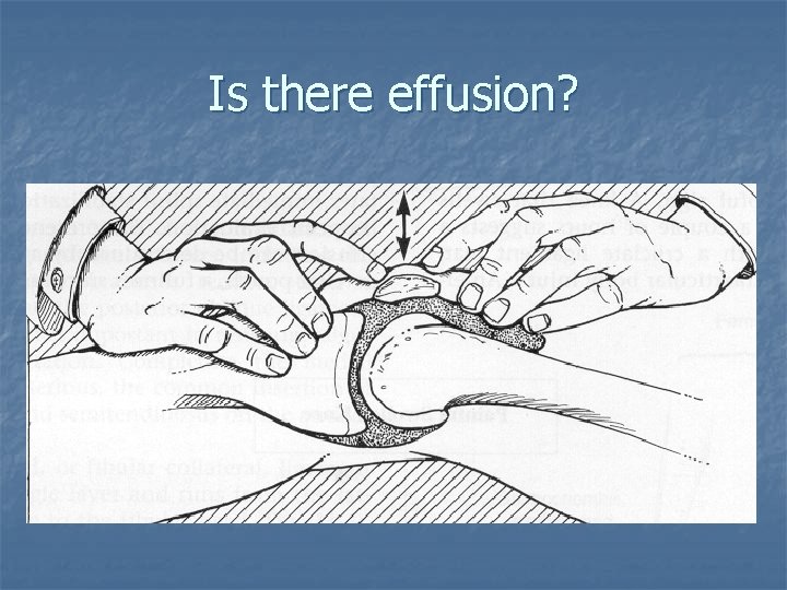 Is there effusion? Is there effusion?