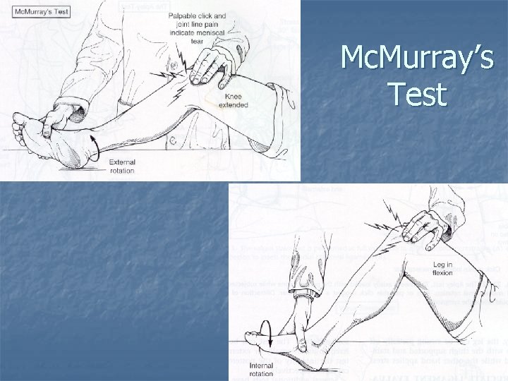 Mc. Murray’s Test Mc. Murray’s Test