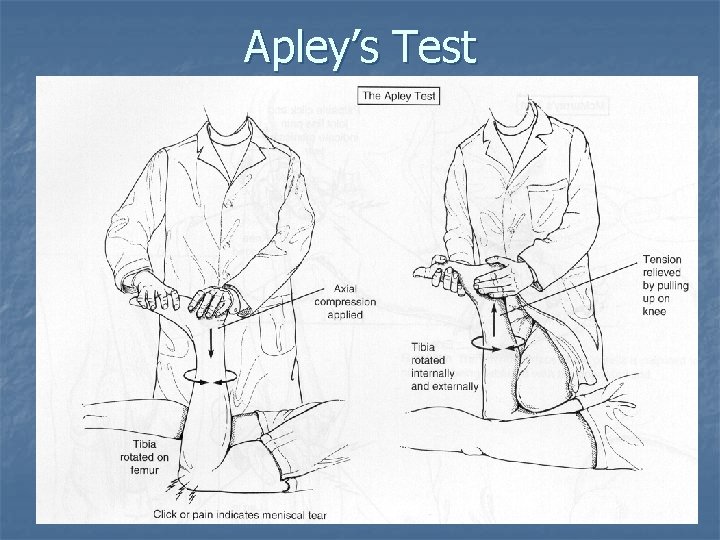 Apley’s Test Apley’s Test