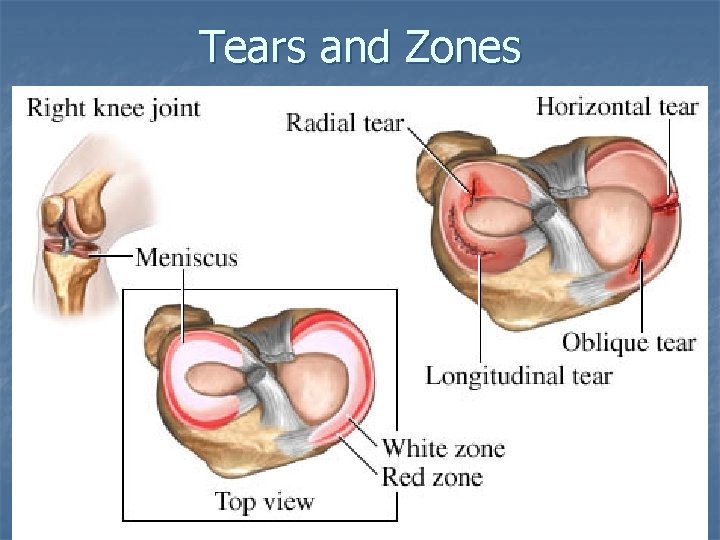 Tears and Zones Tears and Zones
