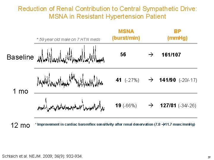 Reduction of Renal Contribution to Central Sympathetic Drive: MSNA in Resistant Hypertension Patient *