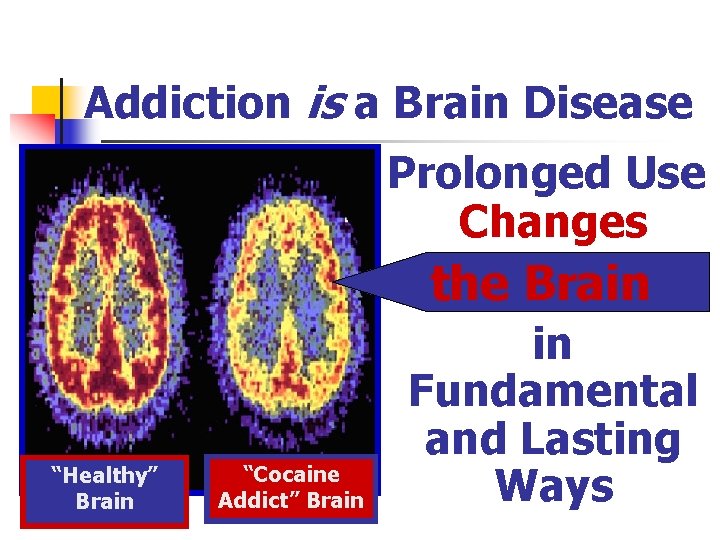 Addiction is a Brain Disease Prolonged Use Changes the Brain “Healthy” Brain “Cocaine Addict”