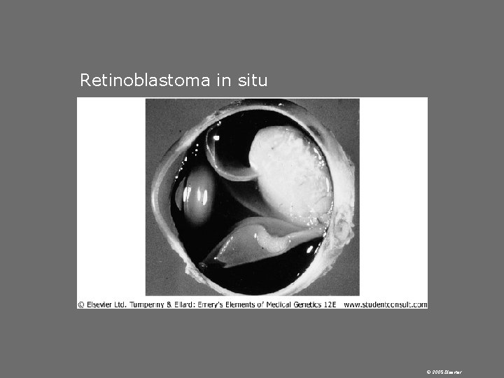  Retinoblastoma in situ © 2005 Elsevier 