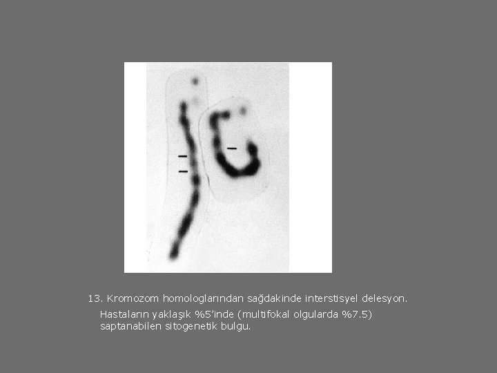 13. Kromozom homologlarından sağdakinde interstisyel delesyon. Hastaların yaklaşık %5’inde (multifokal olgularda %7. 5) saptanabilen