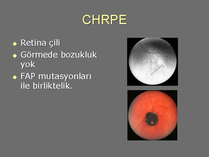 CHRPE u u u Retina çili Görmede bozukluk yok FAP mutasyonları ile birliktelik. 