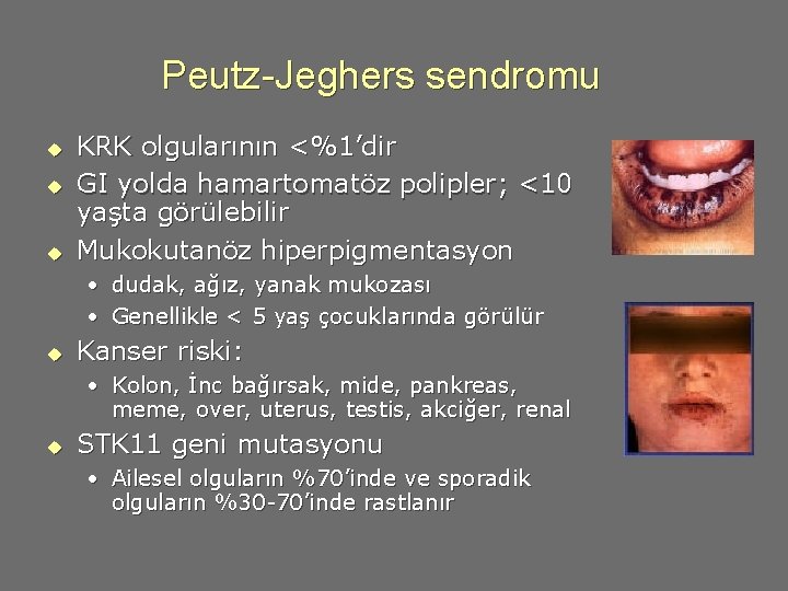 Peutz-Jeghers sendromu u KRK olgularının <%1’dir GI yolda hamartomatöz polipler; <10 yaşta görülebilir Mukokutanöz