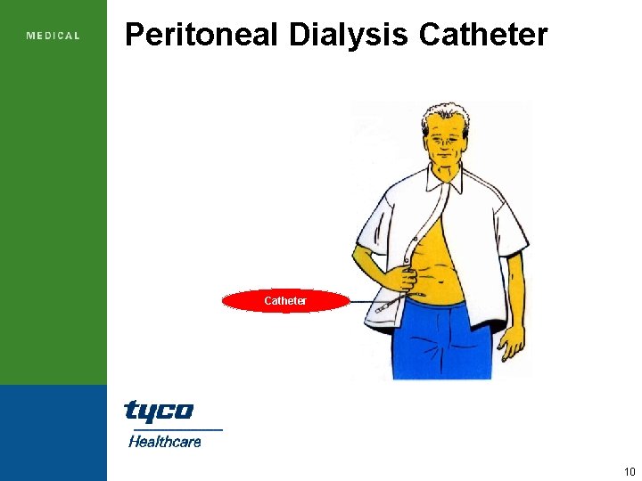 Peritoneal Dialysis Catheter 10 
