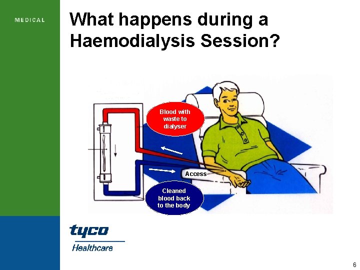 What happens during a Haemodialysis Session? Blood with waste to dialyser Access Cleaned blood