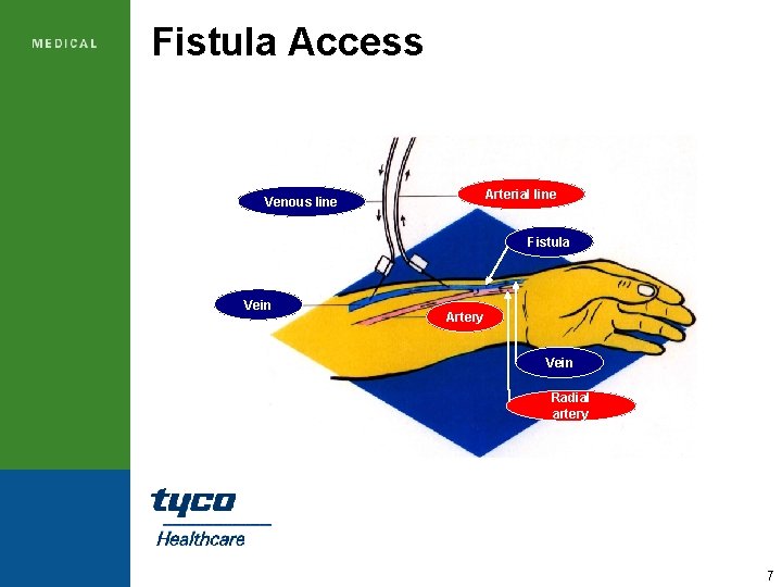 Fistula Access Arterial line Venous line Fistula Vein Artery Vein Radial artery 7 