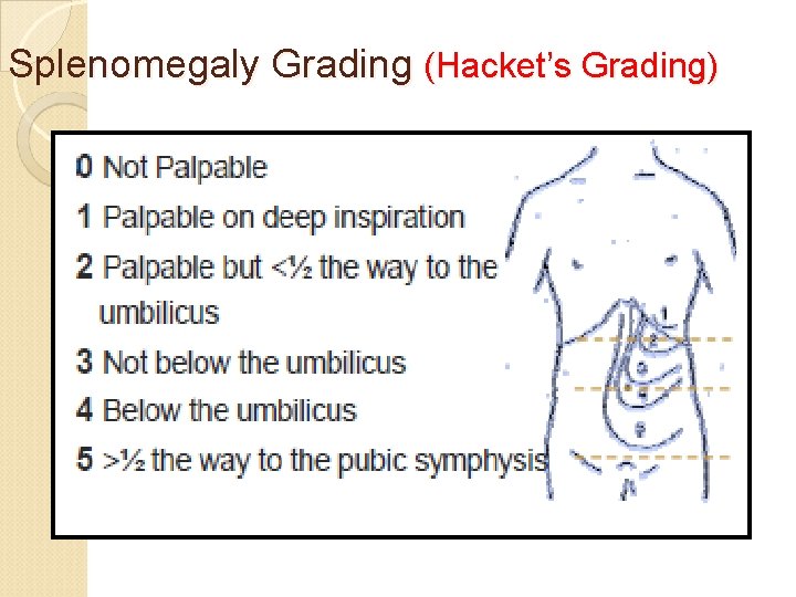 Splenomegaly Grading (Hacket’s Grading) 