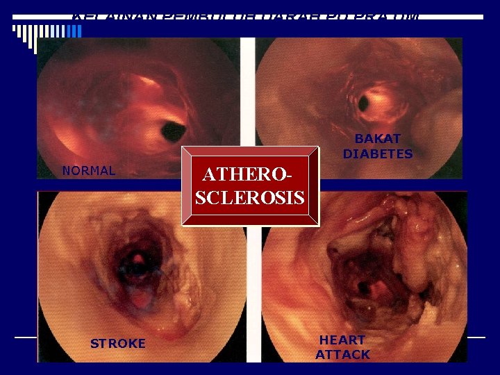 KELAINAN PEMBULUH DARAH PD PRA DM BAKAT DIABETES NORMAL STROKE ATHEROSCLEROSIS HEART 46 ATTACK