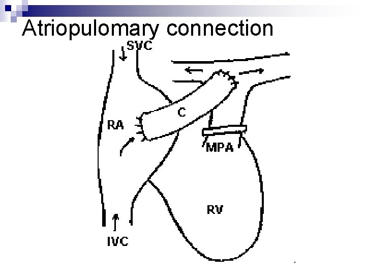 Atriopulomary connection Atriopulomary connection