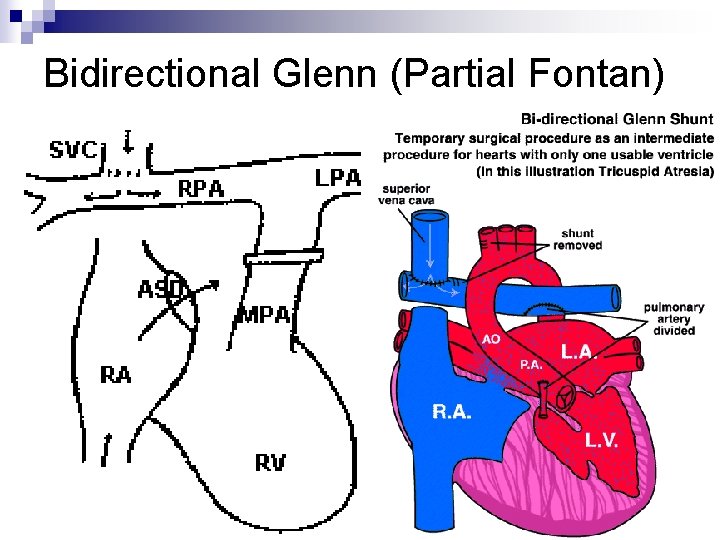 Bidirectional Glenn (Partial Fontan) Bidirectional Glenn (Partial Fontan)