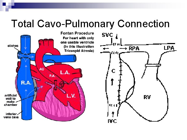 Total Cavo-Pulmonary Connection Total Cavo-Pulmonary Connection