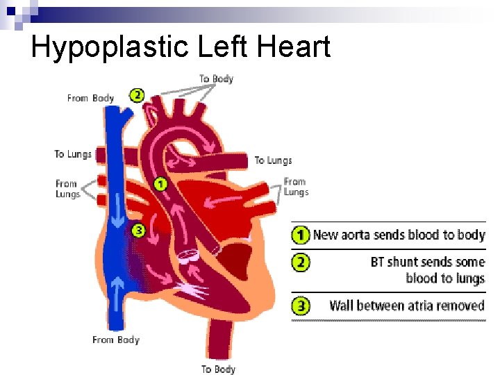 Hypoplastic Left Heart Hypoplastic Left Heart
