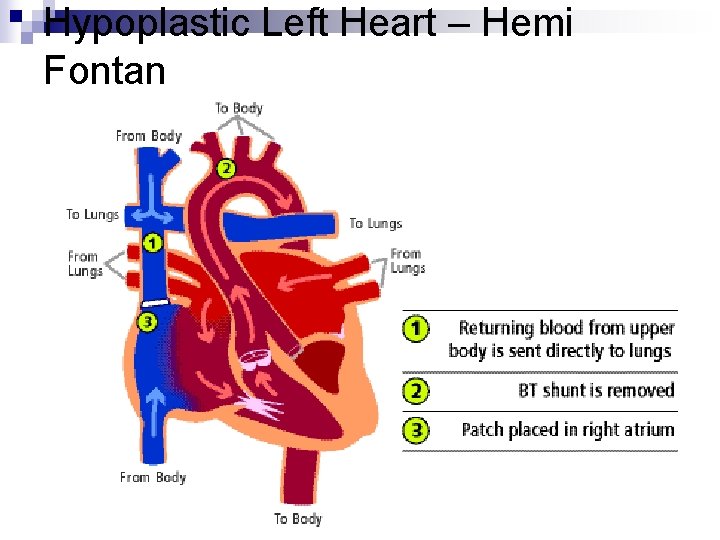 Hypoplastic Left Heart – Hemi Fontan Hypoplastic Left Heart – Hemi Fontan