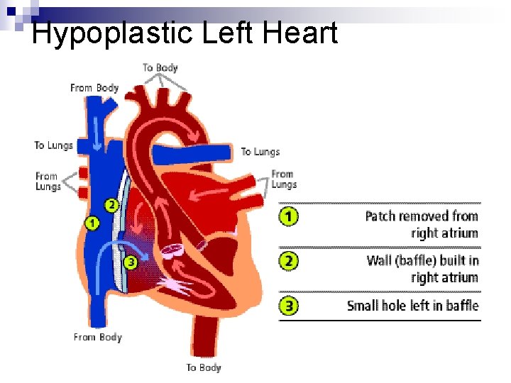 Hypoplastic Left Heart Hypoplastic Left Heart
