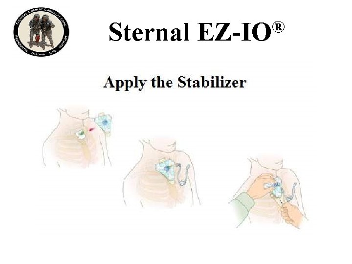 Sternal ® EZ-IO 