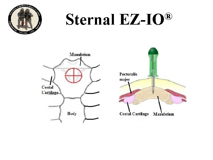 Sternal ® EZ-IO 