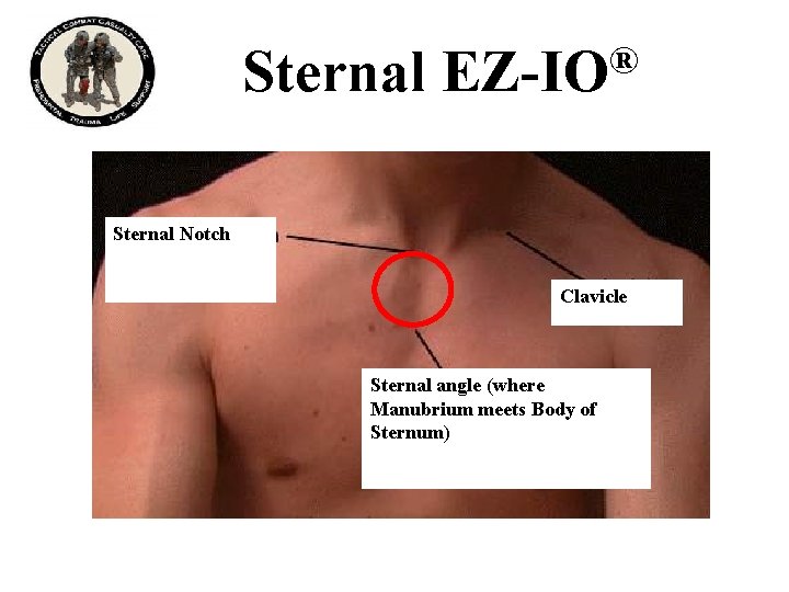 Sternal ® EZ-IO Sternal Notch Clavicle Sternal angle (where Manubrium meets Body of Sternum)