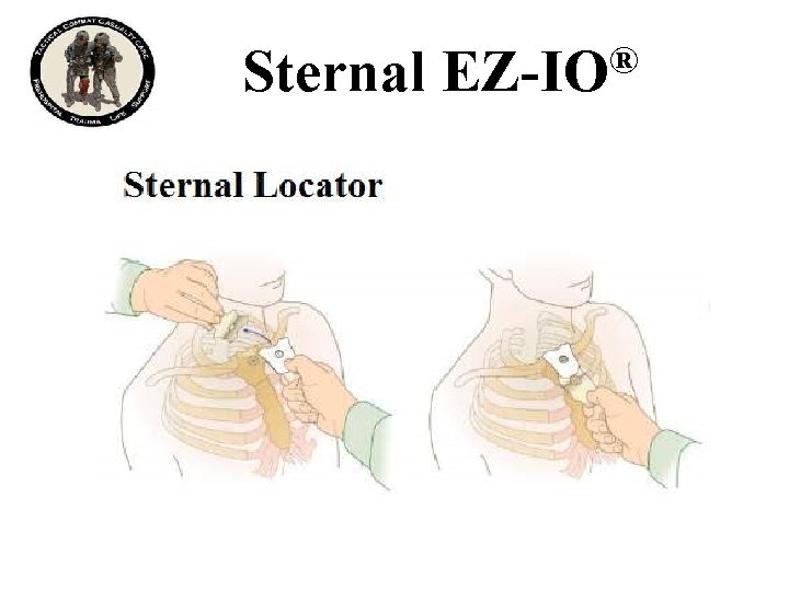 Sternal ® EZ-IO 