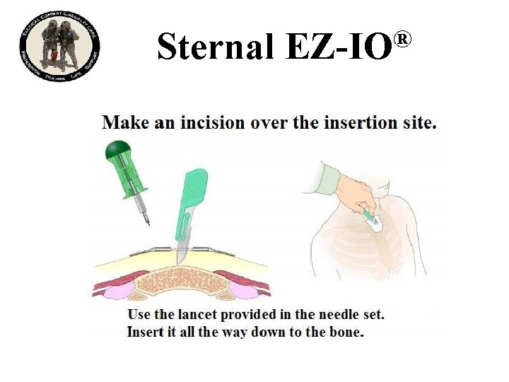 Sternal ® EZ-IO 