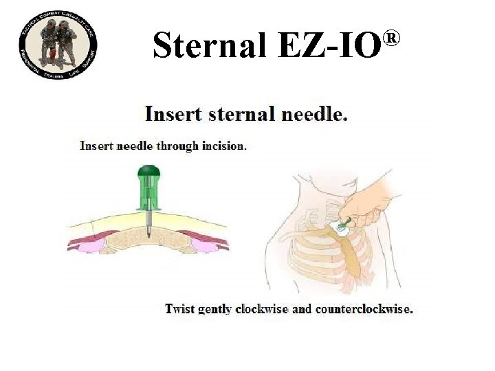 Sternal ® EZ-IO 