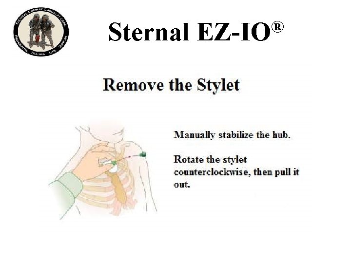 Sternal ® EZ-IO 