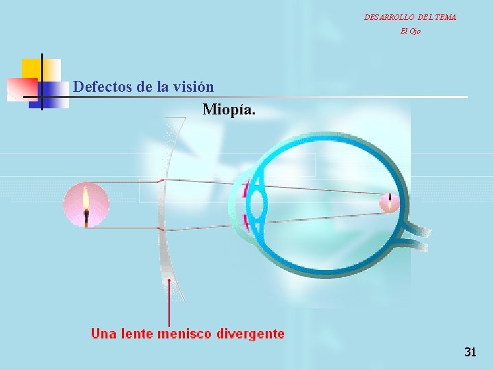 DESARROLLO DEL TEMA El Ojo Defectos de la visión Miopía. 31 