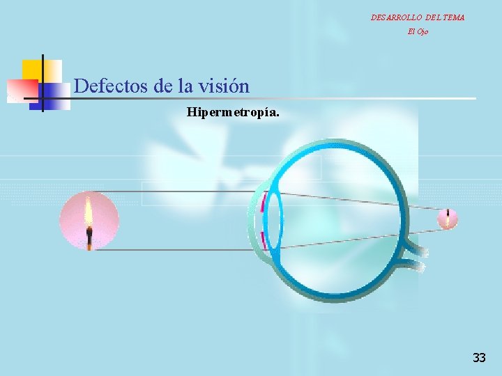 DESARROLLO DEL TEMA El Ojo Defectos de la visión Hipermetropía. 33 