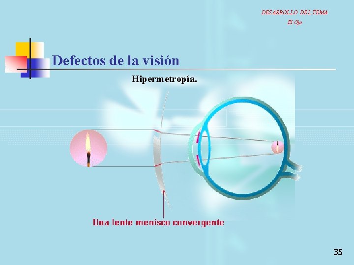 DESARROLLO DEL TEMA El Ojo Defectos de la visión Hipermetropía. 35 