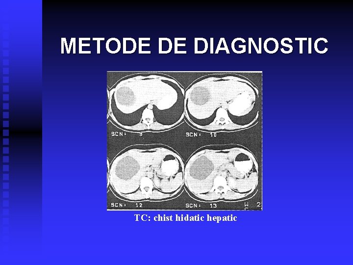 METODE DE DIAGNOSTIC TC: chist hidatic hepatic 