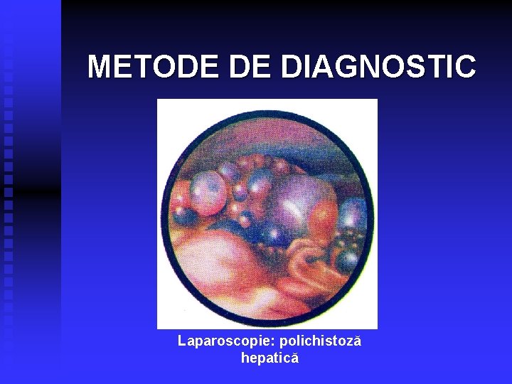 METODE DE DIAGNOSTIC Laparoscopie: polichistoză hepatică 