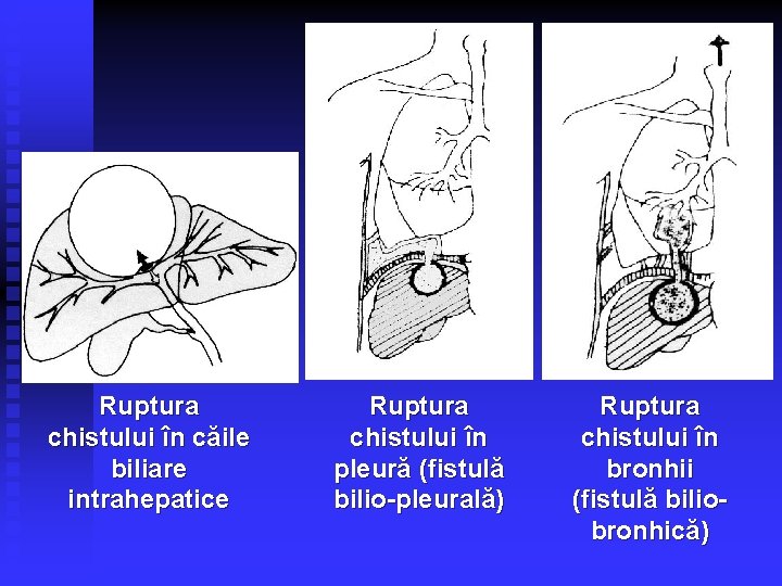 Ruptura chistului în căile biliare intrahepatice Ruptura chistului în pleură (fistulă bilio-pleurală) Ruptura chistului