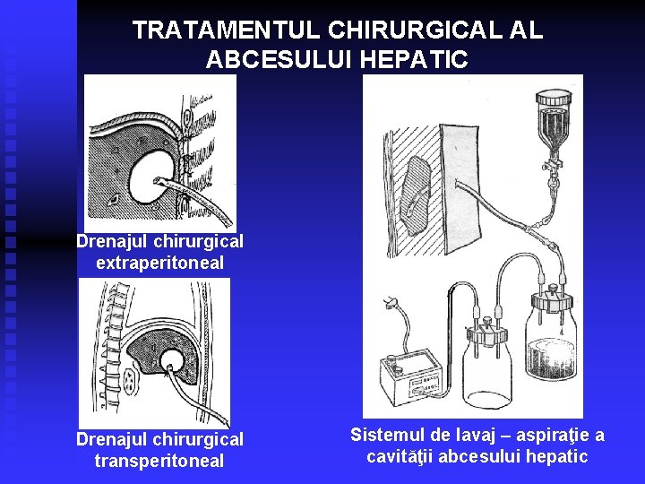 TRATAMENTUL CHIRURGICAL AL ABCESULUI HEPATIC Drenajul chirurgical extraperitoneal Drenajul chirurgical transperitoneal Sistemul de lavaj