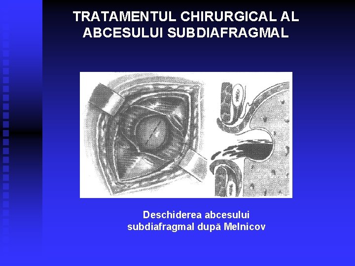 TRATAMENTUL CHIRURGICAL AL ABCESULUI SUBDIAFRAGMAL Deschiderea abcesului subdiafragmal după Melnicov 