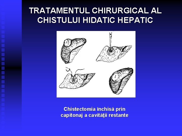 TRATAMENTUL CHIRURGICAL AL CHISTULUI HIDATIC HEPATIC Chistectomia închisă prin capitonaj a cavităţii restante 