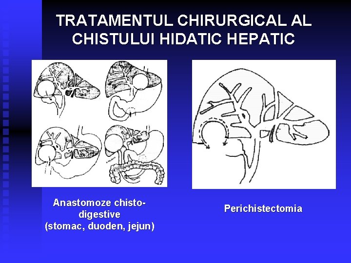 TRATAMENTUL CHIRURGICAL AL CHISTULUI HIDATIC HEPATIC Anastomoze chistodigestive (stomac, duoden, jejun) Perichistectomia 