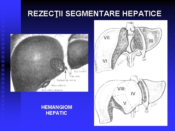  REZECŢII SEGMENTARE HEPATICE HEMANGIOM HEPATIC 