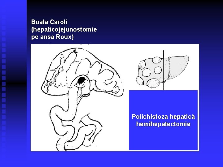 Boala Caroli (hepaticojejunostomie pe ansa Roux) Polichistoza hepatică hemihepatectomie 