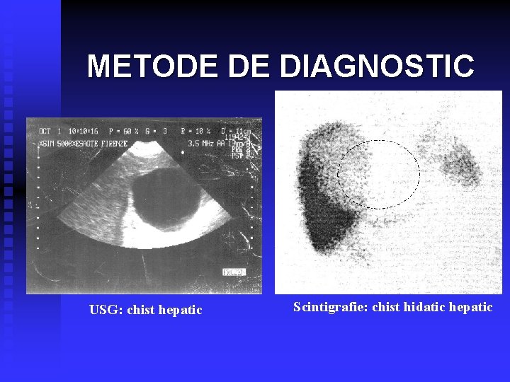 METODE DE DIAGNOSTIC USG: chist hepatic Scintigrafie: chist hidatic hepatic 